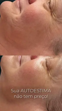 Antes e depois FACE