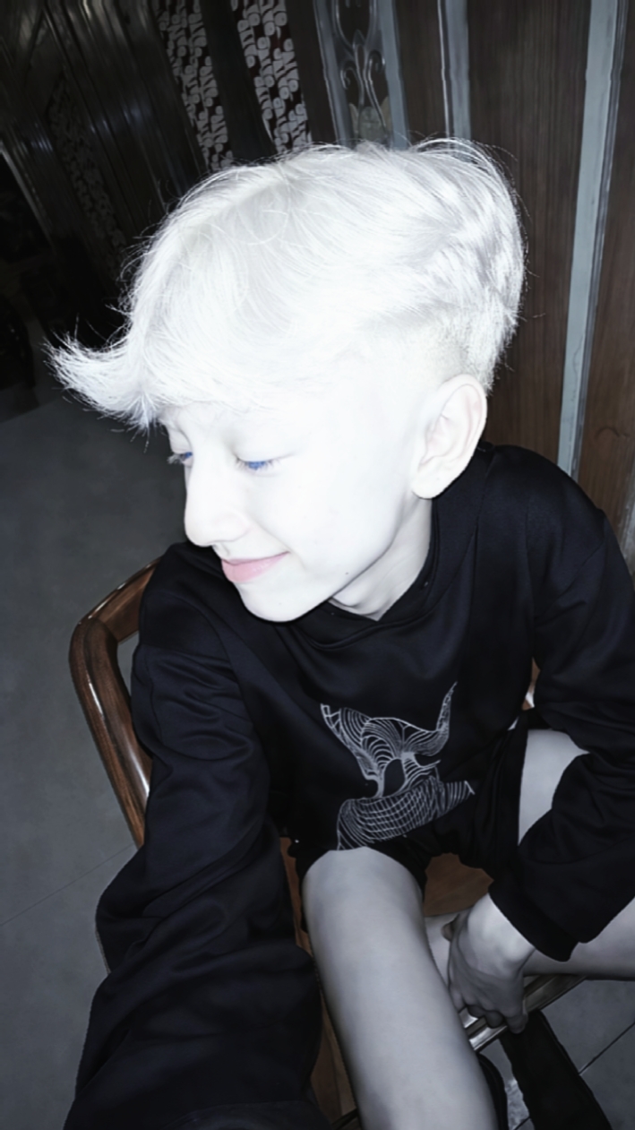 JJ albino