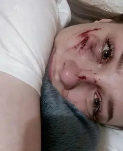 prank wounds