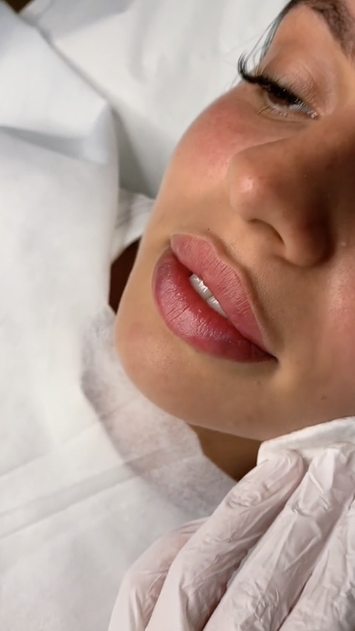 Relleno de labios