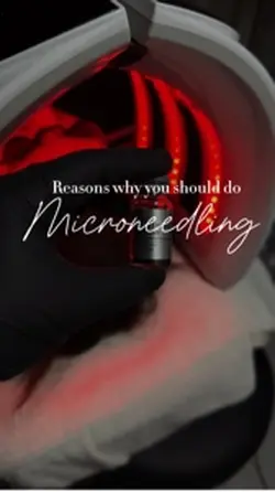 Microneedling ❤️