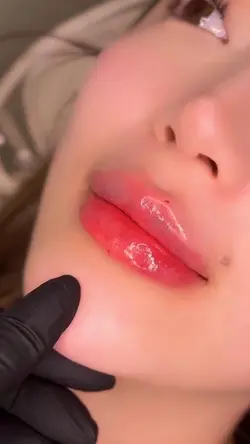 Lip filler