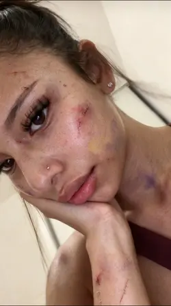 IA INJURIES EFFECT