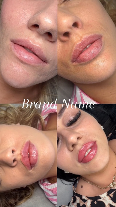 Relleno de labios