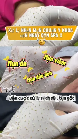 Xử lý mụn