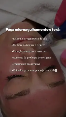 Microagulhamento