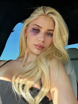 Fake Black Eye 