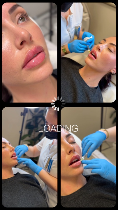 Relleno de labios