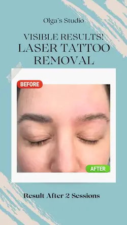 Laser Tattoo Removal