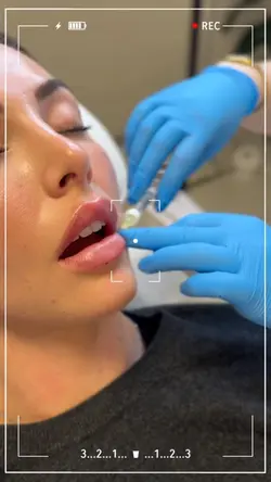 Lip filler