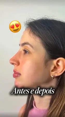 Antes e depois 