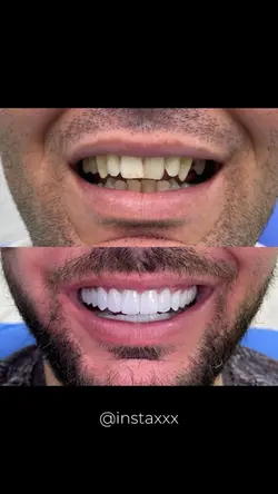 Antes e depois tooth