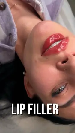 Preenchimento labial