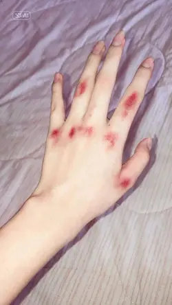 prank hand injury