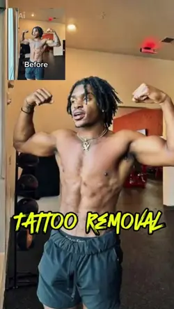 tattoo removal
