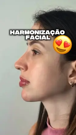 Harmonização facial 