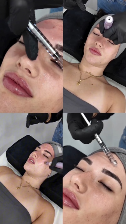 Microneedlingaesthet