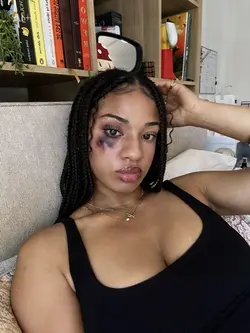 Black eye effect 