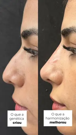Antes e depois NARIZ