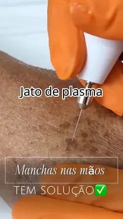 Jato de plasma mãos