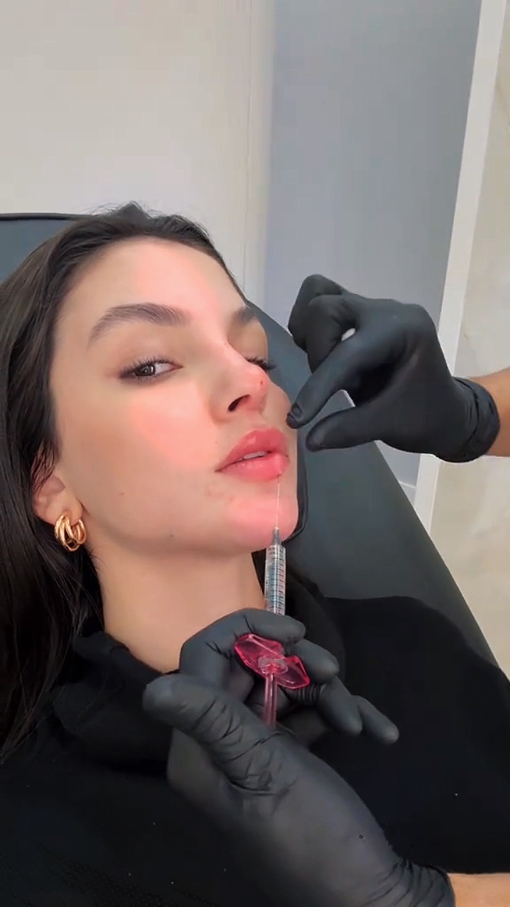 Lip filler