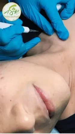 Warts Removal