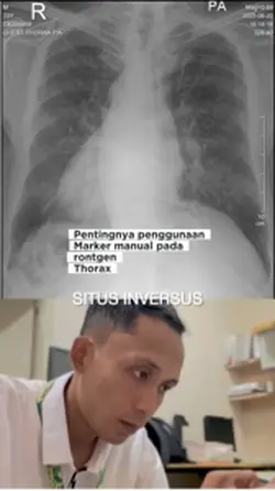 Situsinversus