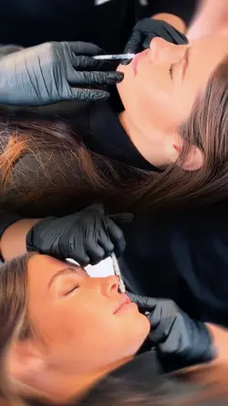 Lip filler