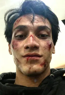 PRANK INJURY 
