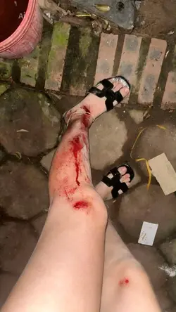 INJURY PRANK 