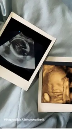 Vidio Foto USG Hamil