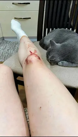 injury