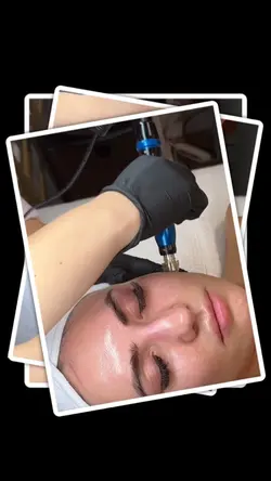 Microneedling aesthe