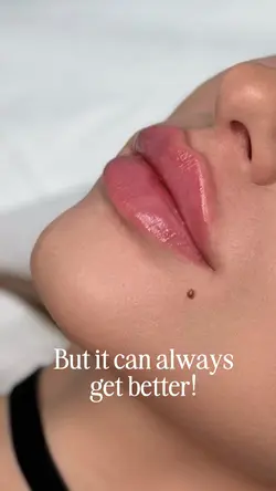 Lip filler
