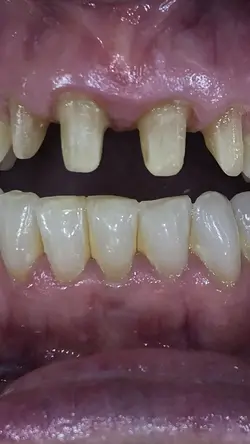 Antes depois dente