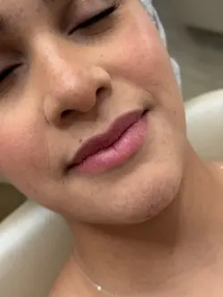 Antes Depois Lábio
