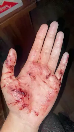 INJURY trend