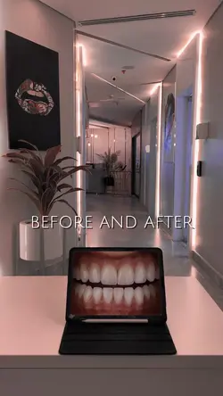 Before and after 🦷