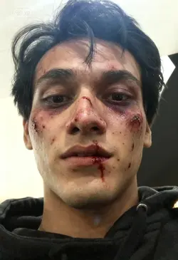 injury after fight