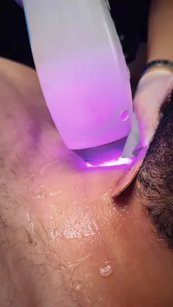 Lazer Epilasyon