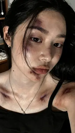 AI Injury