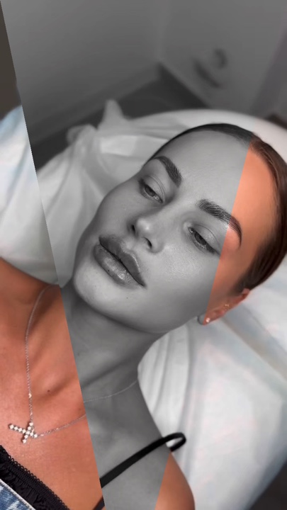 Lip filler