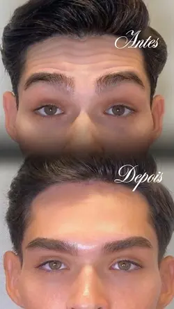 Antes e depois botox