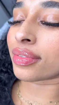 Microneedling aesthe