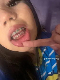 BRACES😻