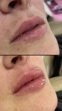 ANTES E DEPOIS