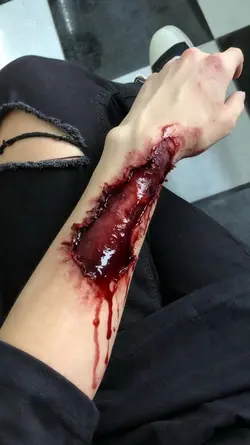 AI Wounds