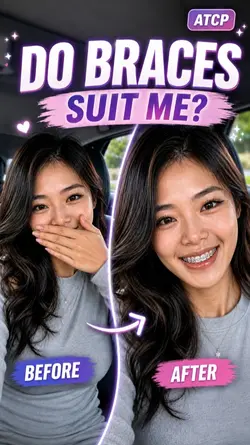 Do Braces Suit Me?