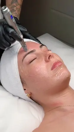 Microneedling