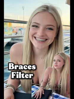 Braces Filter